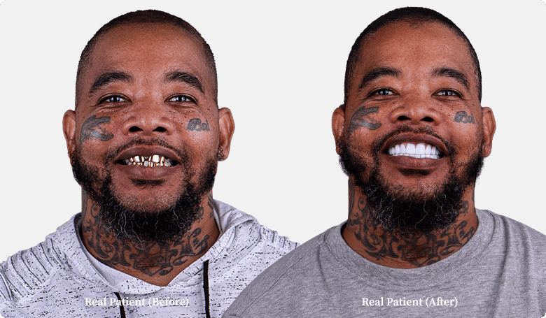 Black middle age patient of Dental Clinic Mexico dental crowns before and after pictures