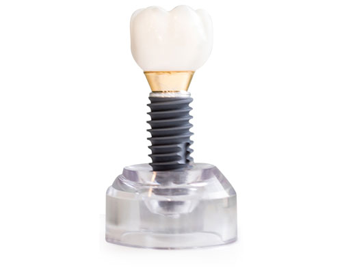 dental implant and a porcelain crown