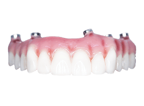 All on 4 acrylic denture cost in Mexico