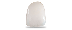 Composite veneers cost in Los Algodones, Mexico