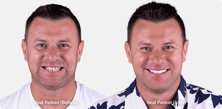 Dental crowns before and after comparison of a middle-aged man, patient of Dr. Hoffmann in Los Algodones