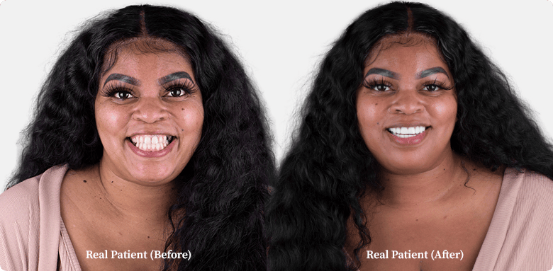 Dental crowns before and after comparison of a middle-aged black woman, patient of Dr. Hoffmann in Los Algodones