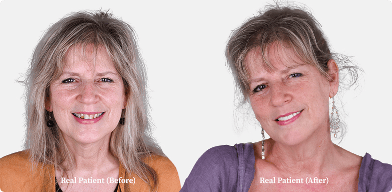 Dental crowns before and after comparison of a middle-aged woman, patient of Dr. Hoffmann in Los Algodones