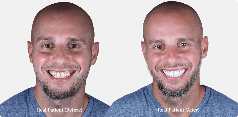 Dental crowns before and after comparison of young bald man, patient of Dr. Hoffmann in Los Algodones