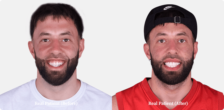 Dental veneers before and after comparison of a young man, patient of Dr. Hoffmann