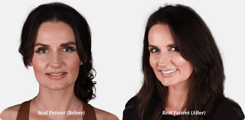 Dental veneers before and after comparison of a middle-aged woman, patient of Dr. Hoffmann