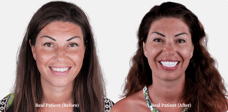 Dental veneers before and after comparison of a young woman, patient of Dr. Hoffmann
