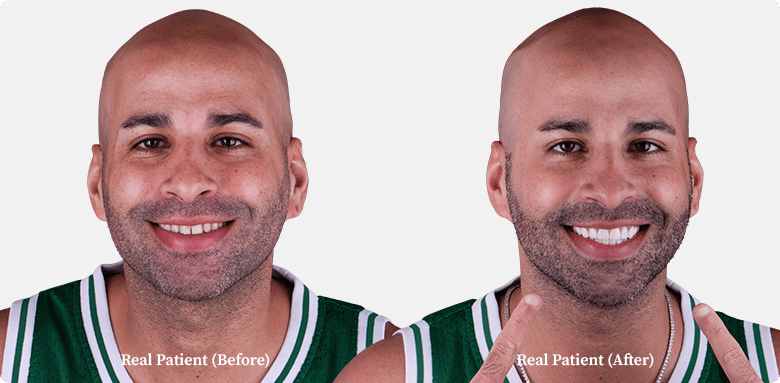 Dental veneers before and after comparison of a young bald man, patient of Dr. Hoffmann