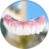 All on 4 dental implants cost in Los Algodones, Mexico