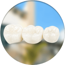 Dental bridges cost in Los Alogodones, Mexico