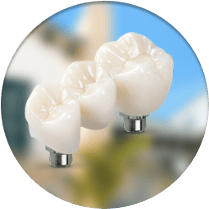 Dental implant bridges cost in Los Alogodones, Mexico