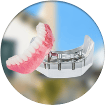 Snap-on-dentures cost in Los Alogodones, Mexico