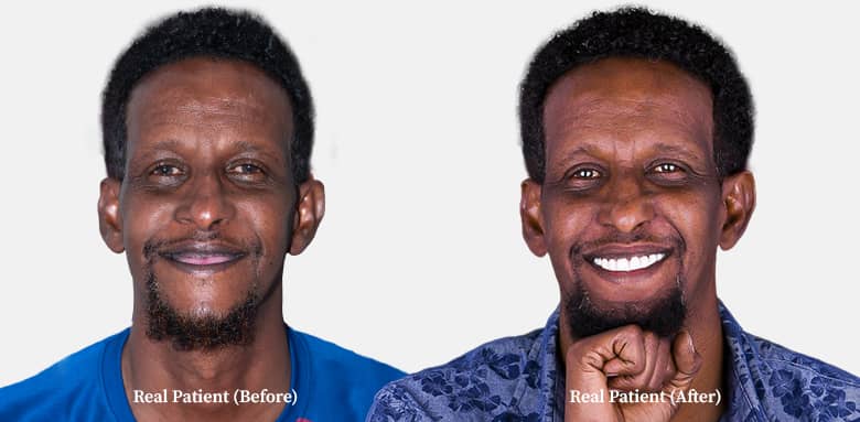 result of your before and after result of your before and after 3 on 6 dental implants