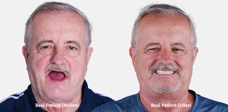 photo of Mr. edentulous before and after
