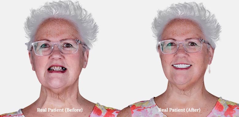average-aged patient 3 on 6 dental implants before and after