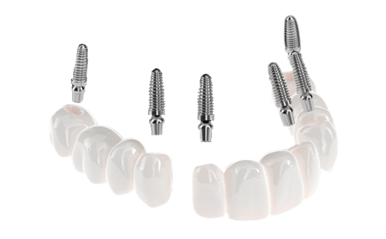 photo of 3 on 6 dental implants