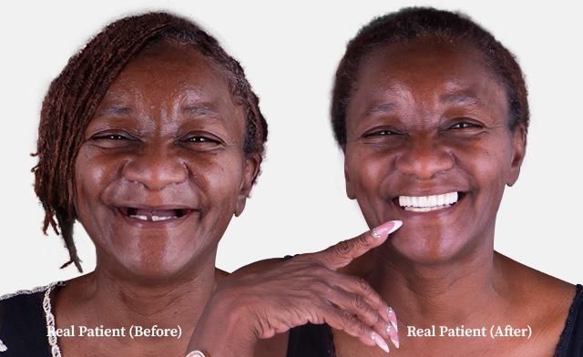Bald middle aged patient all on 4 dental implants before and after pictures