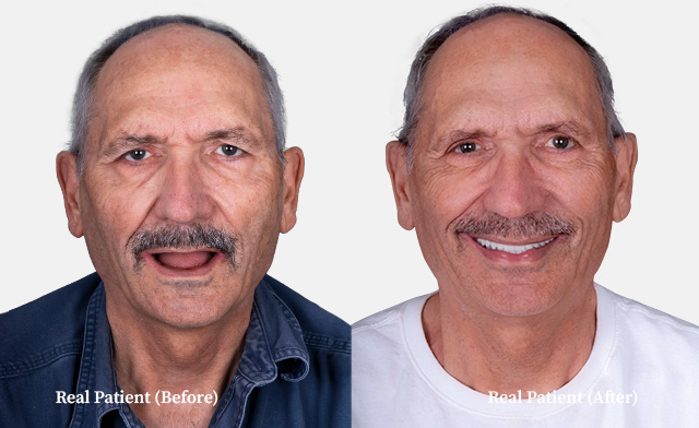 Older man snap on denture before and after photo