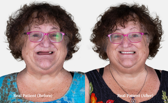 middle aged woman snap on denture before after photos