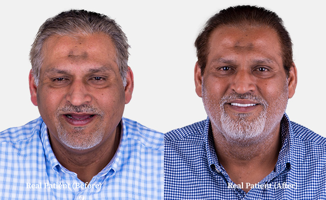 edentulous middle man before after photo