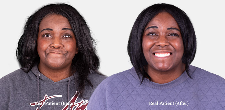 female patient dental implants before and after in Algodones