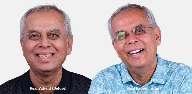 elderly gentleman before and after dental implants
