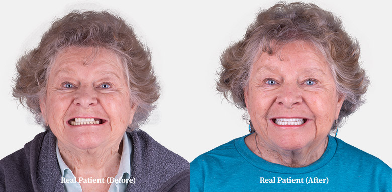 adult of your before and after comparison of dental implants in cottons