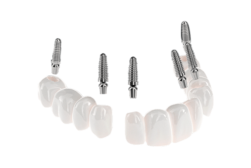 all on 4 dental implants structure