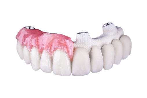 all on 4 dental implants structure