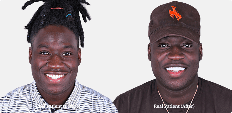 young middle-aged gentleman of his before and after his root canal treatment