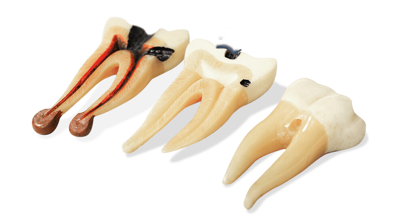 image of a root channel process