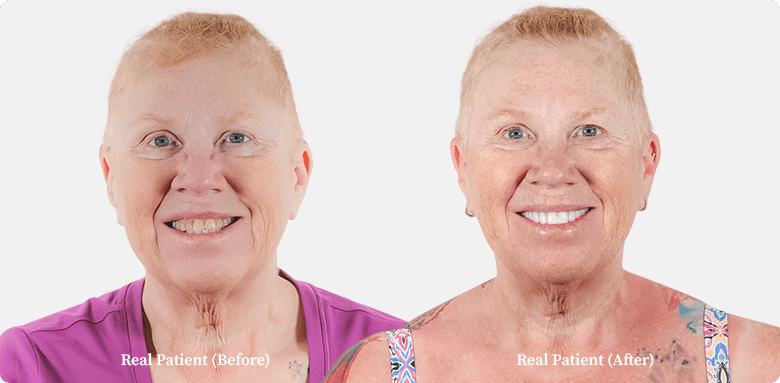 photo of american lady of her before and after her root canal treatment