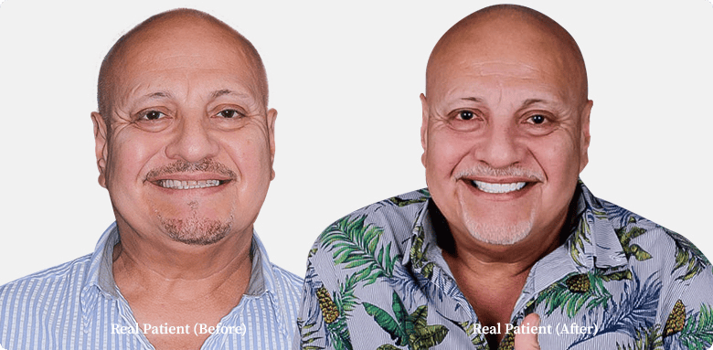 hairless gentleman with his before and after photo of root canal