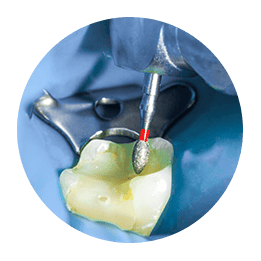 photo of pulp removal from an infected tooth