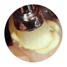 tooth treated and sealed with a durable filling