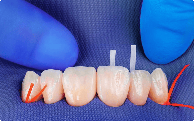 photo of a root canal procedure for a crown