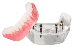 snap on denture 4 mini implants cost algodones mexico