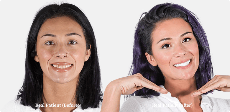 photo of her final result of her smiling teeth whitening girl