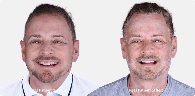 gentleman's photo of his before and after teeth whitening