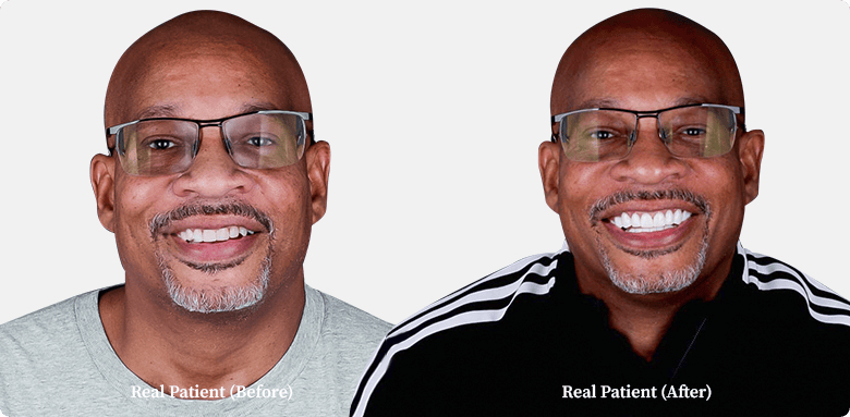 before and after photos of bald man before and after dental whitening dental treatment