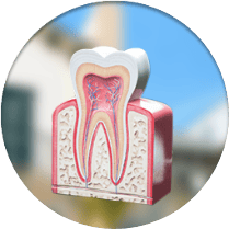cost of endodontics in los algodones mexico