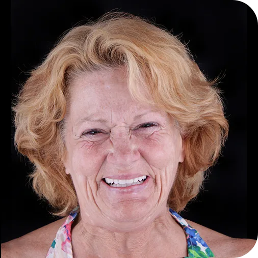 photo of lady of her after her all on 4 dental implants treatment